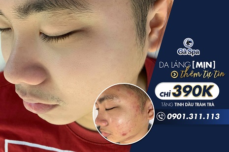 Dịch vụ trị mụn chuyên sâu 8 bước